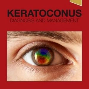 Keratoconus: Diagnosis and Management First Edition