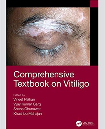 Comprehensive Textbook on Vitiligo 1st Edition