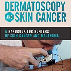 Dermatoscopia e cancro della pelle: un manuale per i cacciatori di cancro della pelle e melanoma