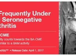 Imágenes de 2017 de espondiloartritis seronegativa frecuentemente poco reconocida