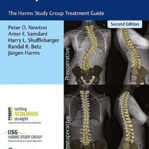 Idiopathic Scoliosis: The Harms Study Group Treatment Guide 2nd Edition