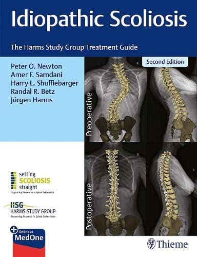 Idiopathic Scoliosis: The Harms Study Group Treatment Guide 2nd Edition