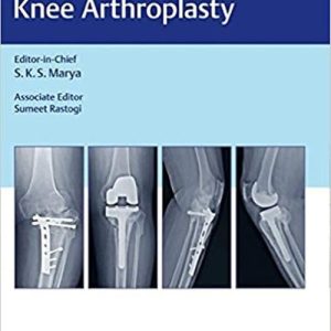 Complex Primary Total Knee Arthroplasty (1st ed/1e) First Edition