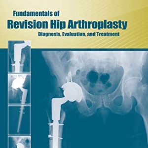 Fundamentals of Revision Hip Arthroplasty : Diagnosis, Evaluation, and & Treatment.