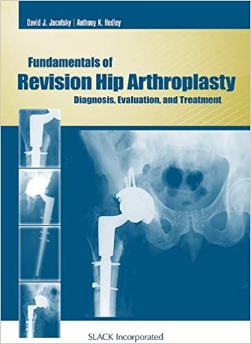 Fundamentals of Revision Hip Arthroplasty : Diagnosis, Evaluation, and & Treatment.