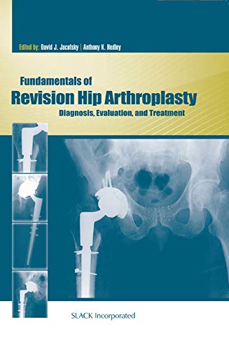 Fundamentals of Revision Hip Arthroplasty : Diagnosis, Evaluation, and & Treatment. PDF