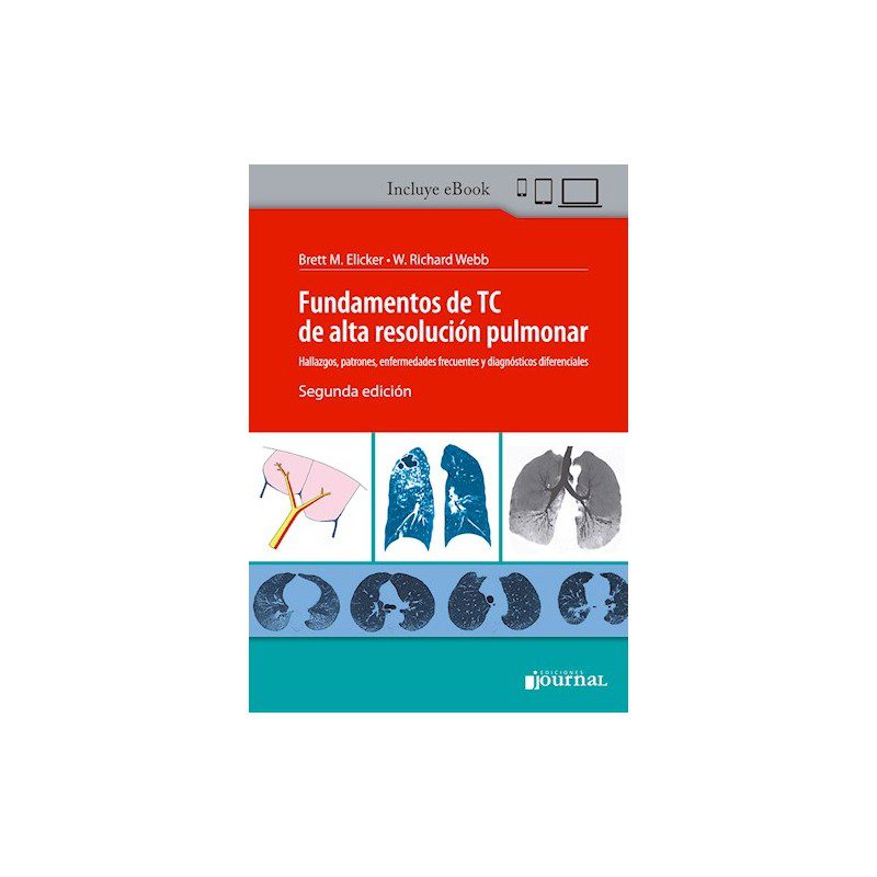 Fundamentos de TC de alta resolución pulmonar Hallazgos, patrones, enfermedades frecuentes y diagnósticos diferenciales 2e, Dos Edición