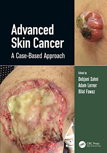 Распространенный рак кожи: индивидуальный подход