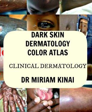 Dark Skin Dermatology Color Atlas: Clinical Dermatology by Dr Miriam Kinai (Author)