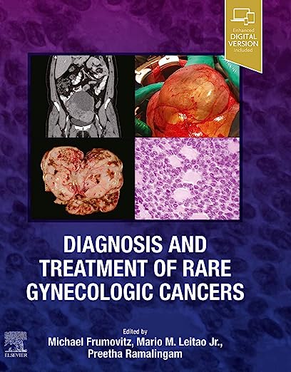 Diagnosis and Treatment of Rare Gynecologic Cancers 1st Edition