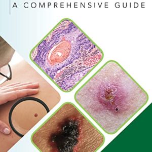 Skin Cancer: A Comprehensive Guide 1st Edition