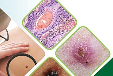 Skin Cancer: A Comprehensive Guide 1st Edition