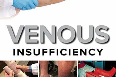 Venous Insufficiency by Raymond Philips