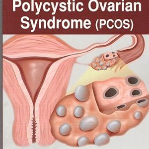 Decoding Polycystic Ovarian Syndrome 1st Edition