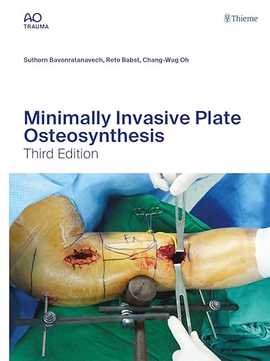 Ostéosynthèse par plaque mini-invasive (AO-Publishing) 3e édition