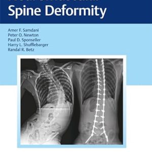 Neuromuscular Spine Deformity 1st Edition