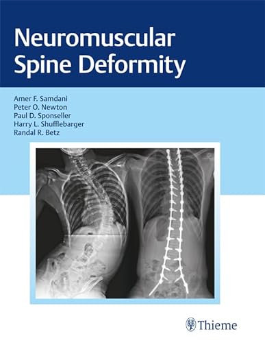 Deformità neuromuscolare della colonna vertebrale 1a edizione