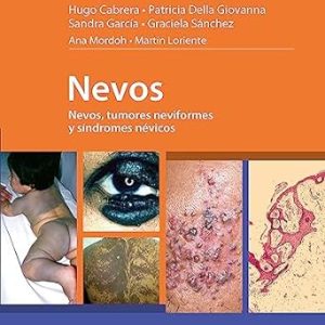 Nevos, Tumores Neviformes y Síndromes Névicos First Edition