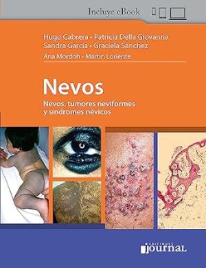Nevos, Tumores Neviformes y Síndromes Névicos First Edition