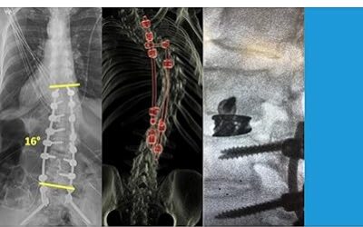 Revision Spine Surgery Pearls and Pitfalls 1st Edition