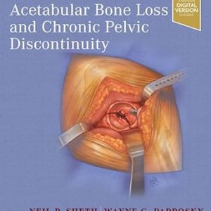 Treatment of Acetabular Bone Loss and Chronic Pelvic Discontinuity 1st Edition