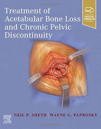 Trattamento della perdita ossea acetabolare e della discontinuità pelvica cronica 1a edizione
