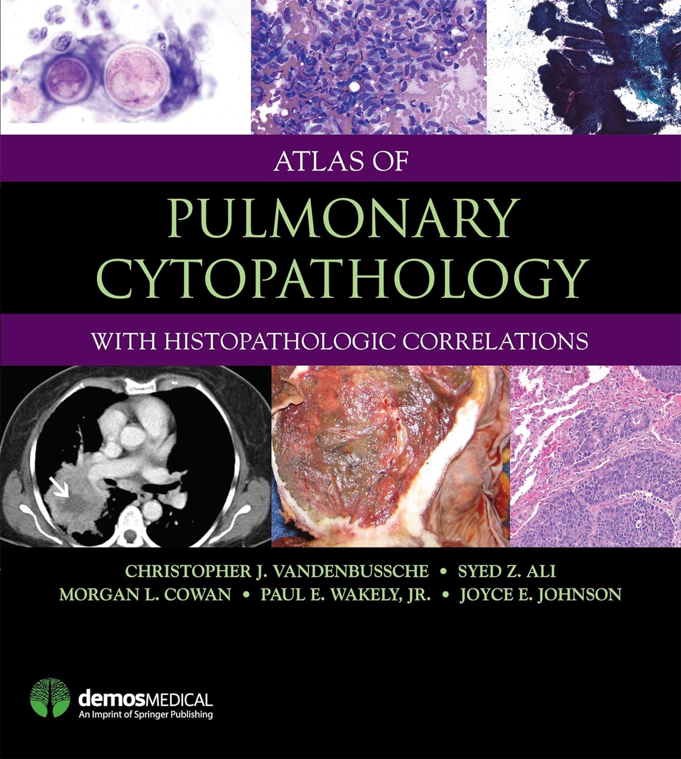 Atlas of Pulmonary Cytopathology 1st Edition