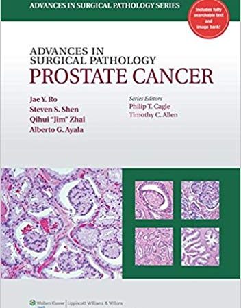 Advances in Surgical Pathology – Prostate Cancer PDF