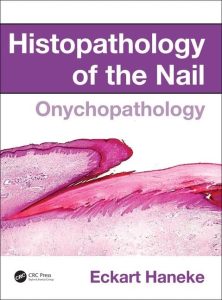 Histopathology of the Nail – Onychopathology