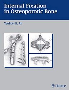 Internal Fixation in Osteoporotic Bone 1st Edition