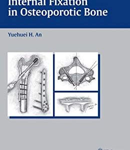 Internal Fixation in Osteoporotic Bone 1st Edition