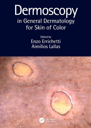 Dermoscopy in General Dermatology for Skin of Color 1st Edition PDF  by Enzo Errichetti (Editor), Aimilios Lallas (Editor)