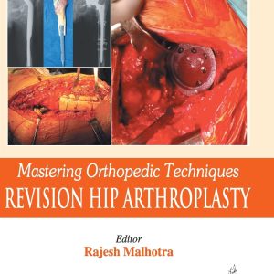 Mastering Orthopedic Techniques Revision Hip Arthroplasty 1st Edition