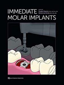 Immediate Molar Implants  First Edition