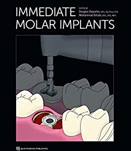 Immediate Molar Implants  First Edition