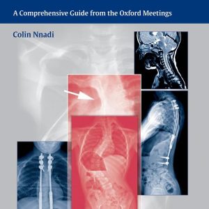 Early Onset Scoliosis  A Comprehensive Guide from the Oxford Meetings First Edition