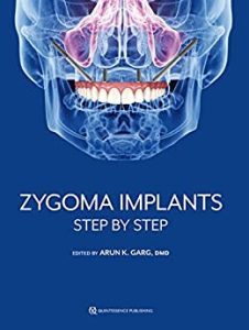 Zygoma Implants: Step by Step First Edition