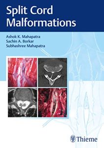 Split Cord Malformations First Edition