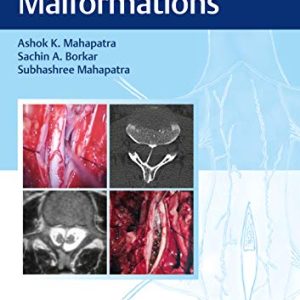 Split Cord Malformations First Edition