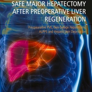 Safe Major Hepatectomy after Preoperative Liver Regeneration Preopearative PVE  Two Satage Hepatetomy ALPPS and Hepatic Vein Deprivation First Edition