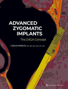 Advanced Zygomatic Implants: The Zaga Concept First Edition