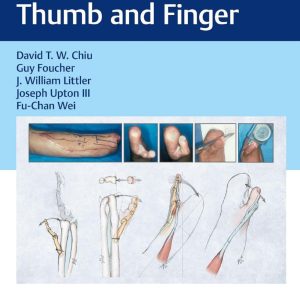 Reconstruction of the Thumb and Finger First Edition