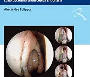 Técnica Centrípeta: Etmoidectomia Endoscópica Endonasal First Edition