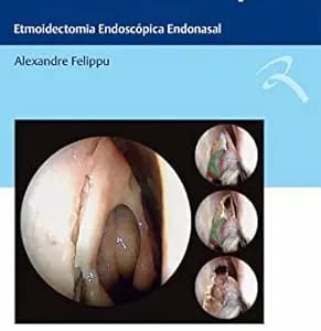 Técnica Centrípeta: Etmoidectomia Endoscópica Endonasal First Edition