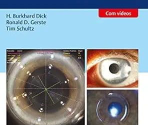 Cirurgia a Laser de Femtossegundo Em Oftalmologia