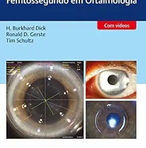 Cirurgia a Laser de Femtossegundo Em Oftalmologia