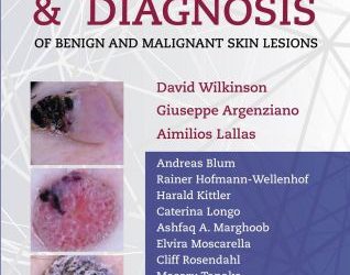 Dermoscopy And Diagnosis Of Benign and Malignant Skin Lesions First Edition