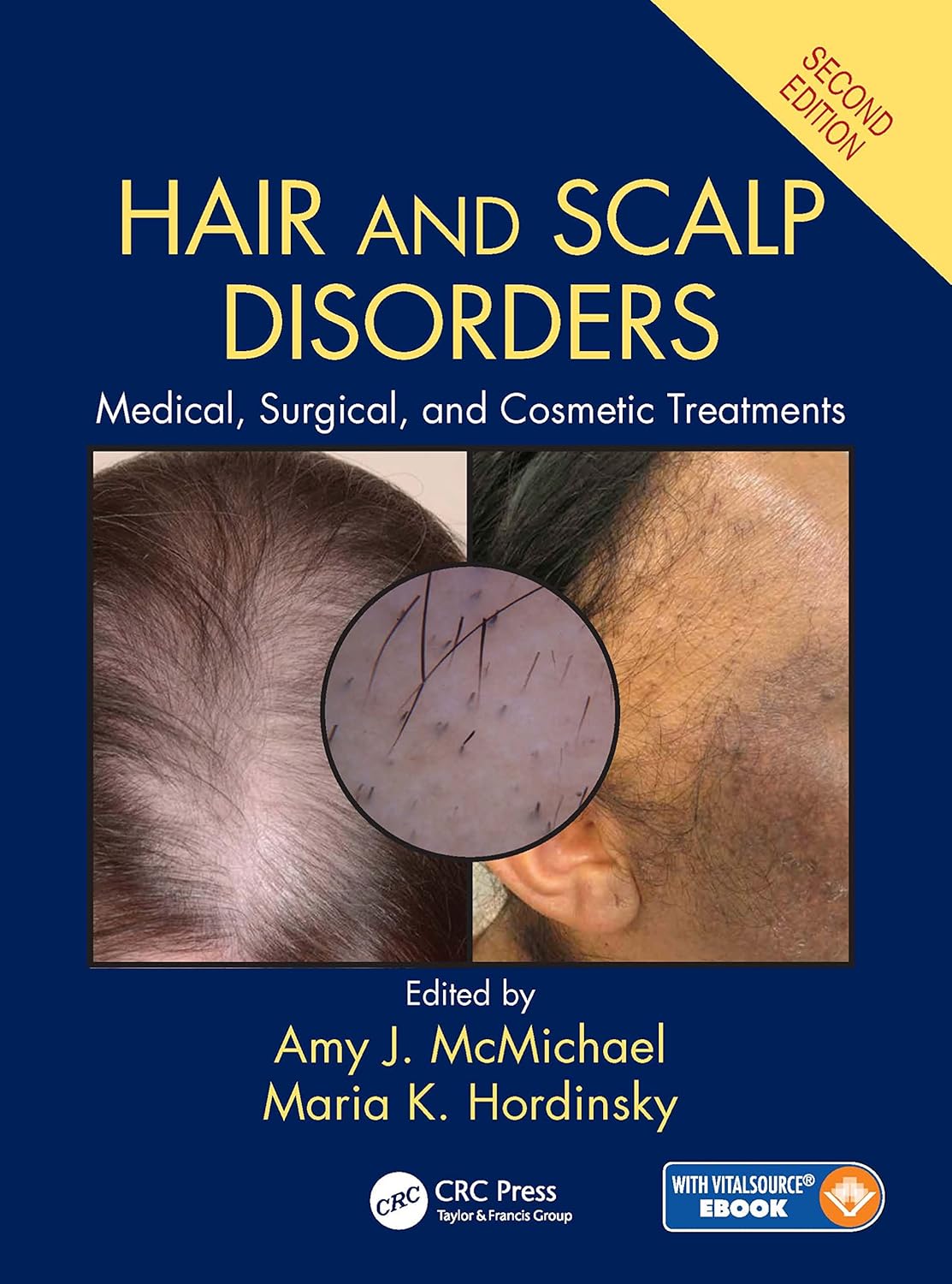 Hair and Scalp Disorders Medical, Surgical, and Cosmetic Treatments Hair and Scalp Disorders: Medical, Surgical, and Cosmetic Treatments 2E