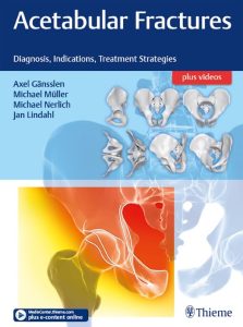 Acetabular Fractures: Diagnosis, Indications, Treatment Strategies First Edition
