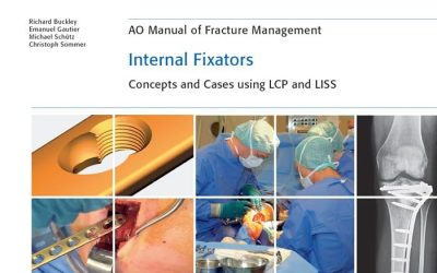 AO Manual of Fracture Management: Internal Fixators: Concepts and Cases using LCP/LISS